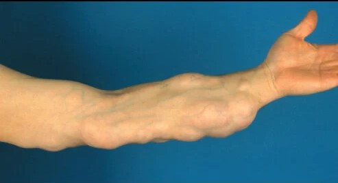 Lipoma